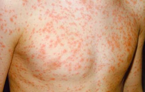 Top 10 Bệnh Xã Hội Phổ Biến Nhất Hiện Nay Top 10 Bệnh Xã Hội Phổ Biến Nhất Hiện Nay