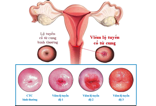 Viêm lộ tuyến cổ tử cung Tổng hợp các bệnh ở vùng kín nữ giới