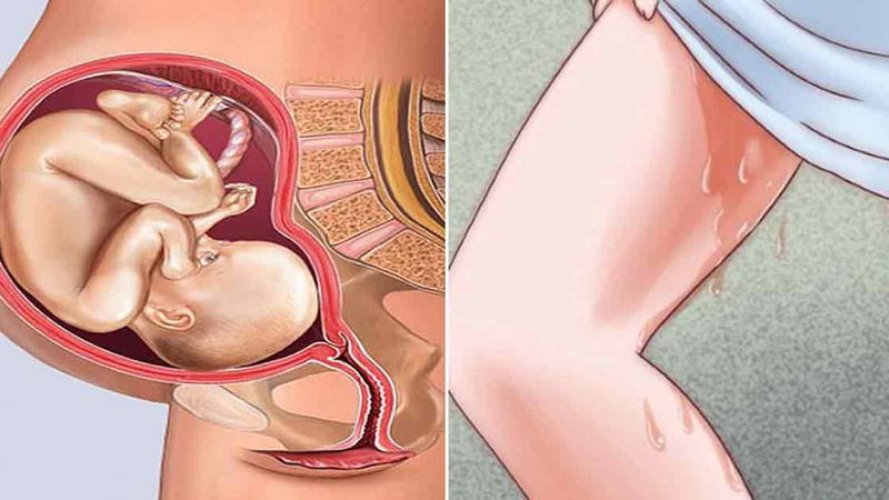 Chuyển dạ vỡ ối: Dấu hiệu, nguyên nhân và cách xử lý
