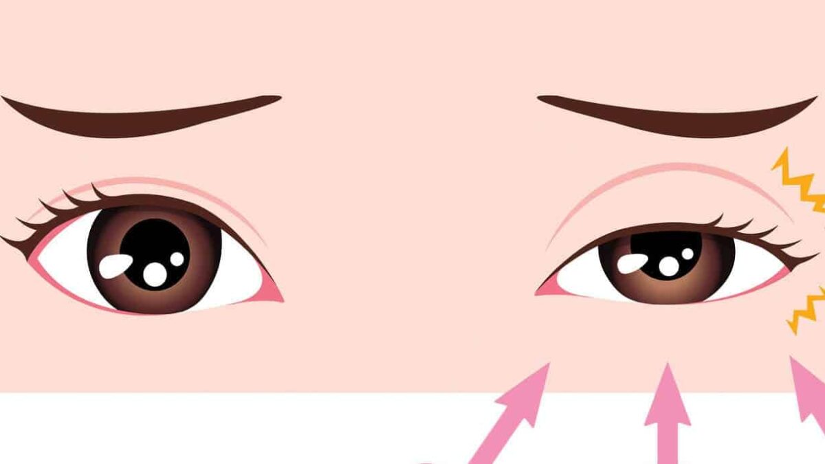 Mắt giật liên tục là triệu chứng của bệnh gì