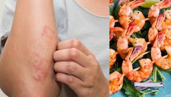 Vì sao bạn bị dị ứng tôm
