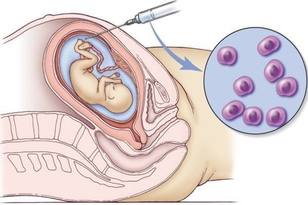 Sinh thiết gai nhau thai: Khi nào cần thực hiện và những lưu ý quan trọng 8 Sinh thiết gai nhau thai: Khi nào cần thực hiện và những lưu ý quan trọng