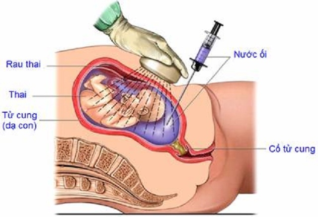 Sinh thiết gai nhau thai: Hiểu rõ hơn để bảo vệ thai nhi an toàn