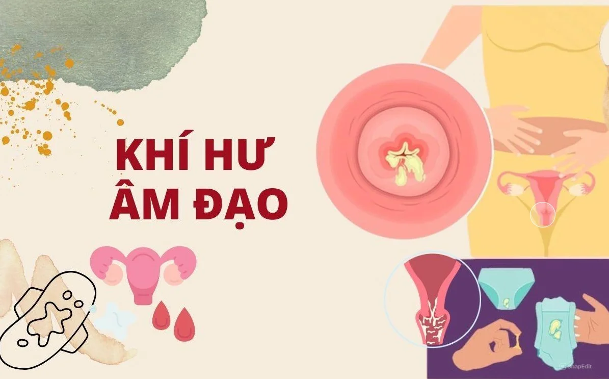 Khí hư âm đạo ở phụ nữ: Nên khám ở đâu?