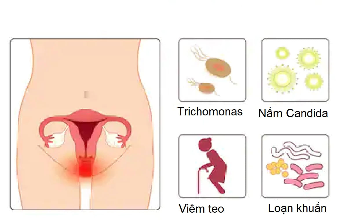 Ngứa rát âm đạo Nguyên nhân, triệu chứng và cách điều trị