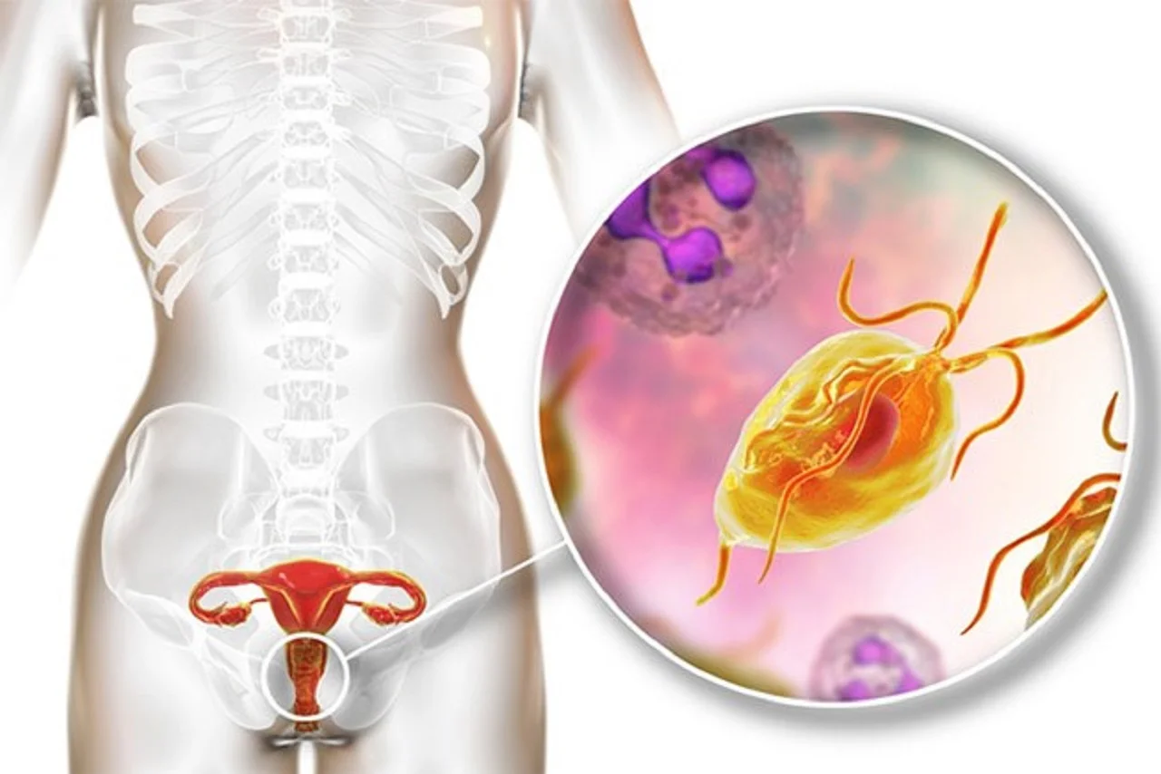 Tìm hiểu về Trichomoniasis - căn bệnh lây truyền qua đường tình dục phổ biến