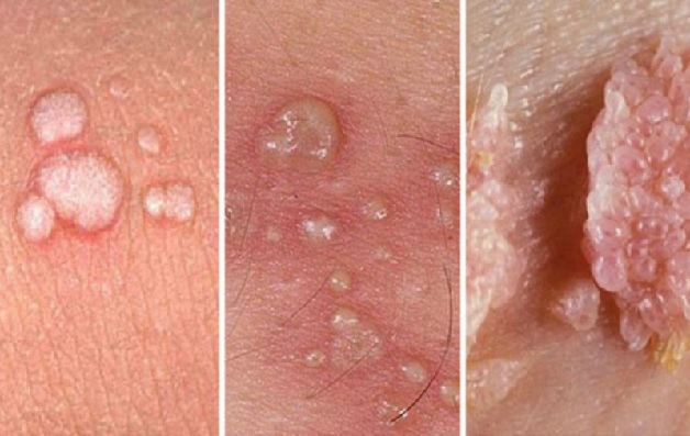 3 Sai lầm Thường Gặp Khi Điều Trị Bệnh Xã Hội
