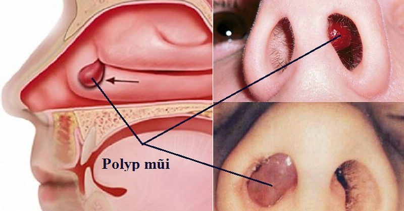 Mất khứu giác? Polyp mũi có thể là thủ phạm! 6 Mất khứu giác? Polyp mũi có thể là thủ phạm!