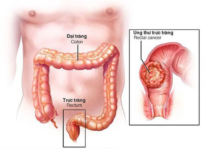 Bạn có biết 3 loại polip này có thể gây ung thư? 4 Bạn có biết 3 loại polip này có thể gây ung thư?