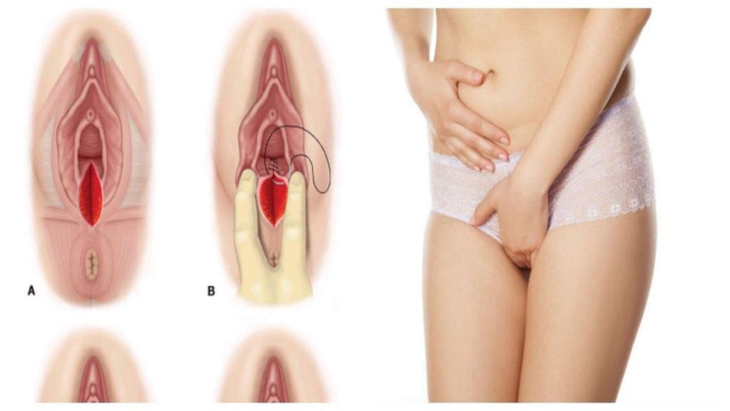 Vùng kín đau rát sau sinh: Mẹ bỉm sữa cần làm gì?