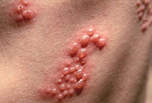 Vùng kín nổi mụn nước, ngứa ngáy, đau rát khi quan hệ: Dấu hiệu bệnh Herpes sinh dục?
