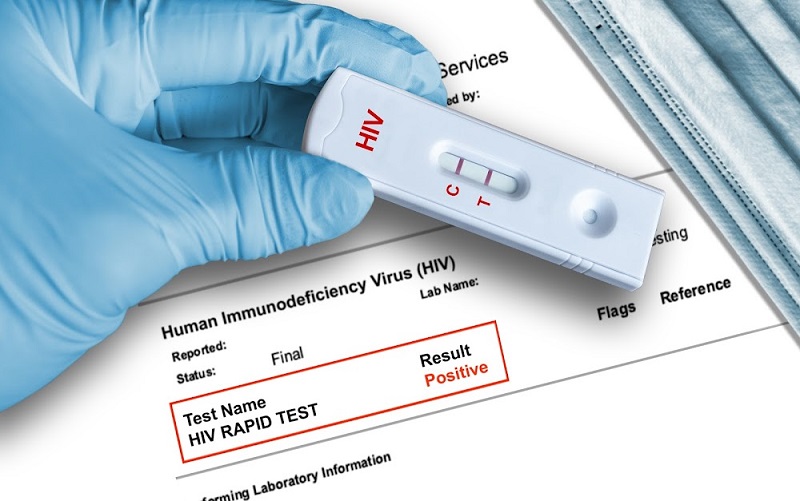 Xét nghiệm HIV có đau không Bao lâu có kết quả