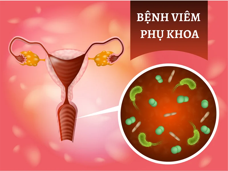 Bị viêm nhiễm phụ khoa là do đâu? 5 nguyên nhân phổ biến chị em cần biết 5 Bị viêm nhiễm phụ khoa là do đâu (1)