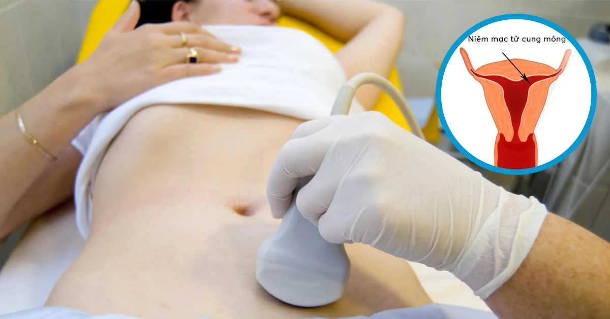 Niêm mạc tử cung mỏng uống gì để dày lên? Không phải ai cũng cần estrogen 9 Niêm mạc tử cung mỏng uống gì để dày lên? Không phải ai cũng cần estrogen