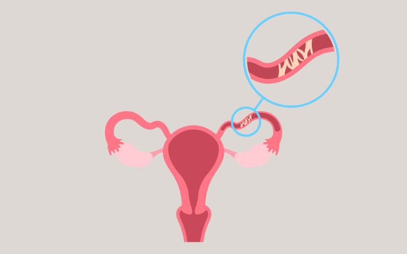 Tắc vòi trứng nặng – Có nên cố mang thai tự nhiên hay chuyển hướng IVF