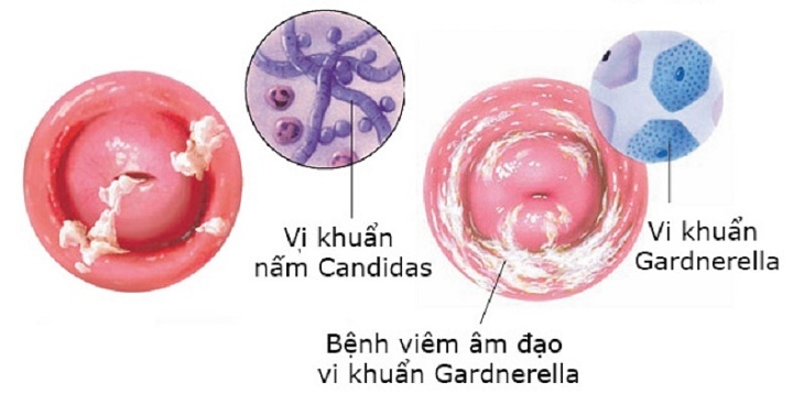 Viêm âm đạo do vi khuẩn – Dấu hiệu và cách chữa 4 Viêm âm đạo do vi khuẩn