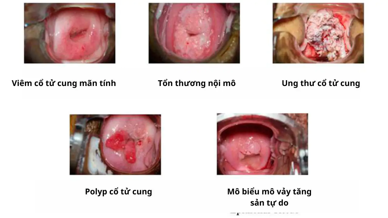 Viêm cổ tử cung có chữa dứt điểm được không? 6 Viêm cổ tử cung có chữa dứt điểm được không