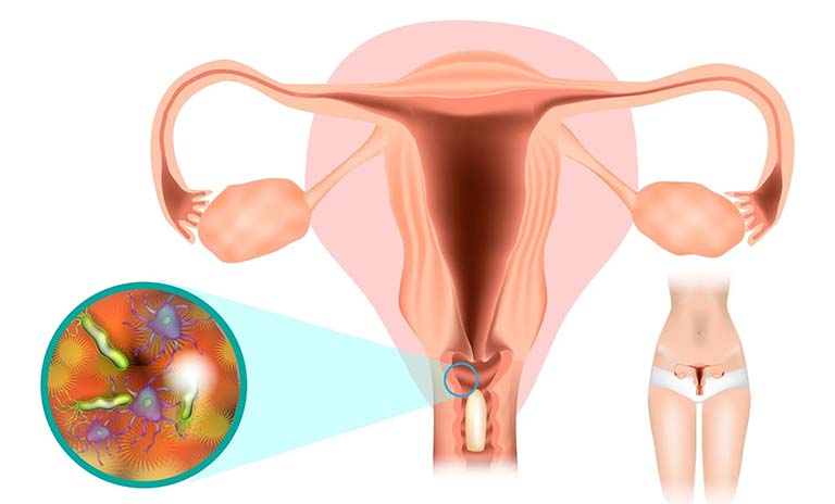 Viêm nhiễm phụ khoa lâu năm có ảnh hưởng đến sinh sản không