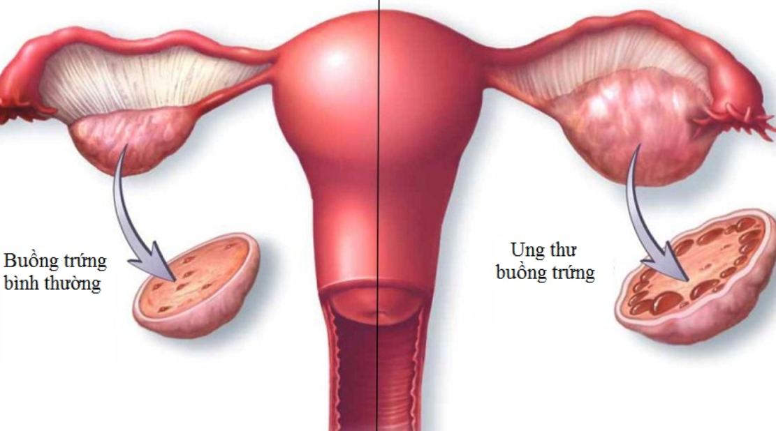 Ung thư buồng trứng là gì