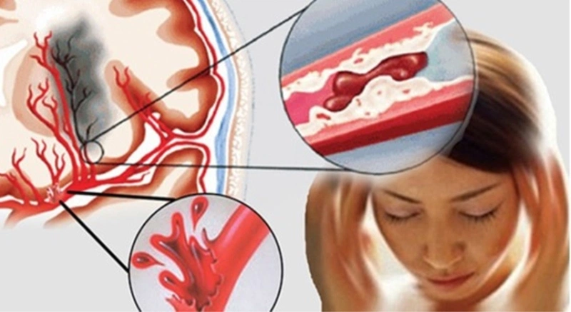 WHO khuyến cáo gì trong phòng ngừa và điều trị đột quỵ