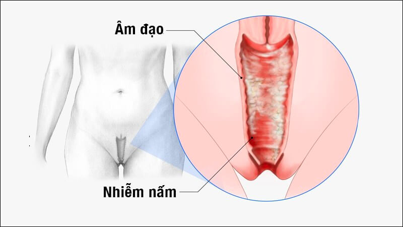 Viêm âm đạo tái phát nhiều lần là do đâu
