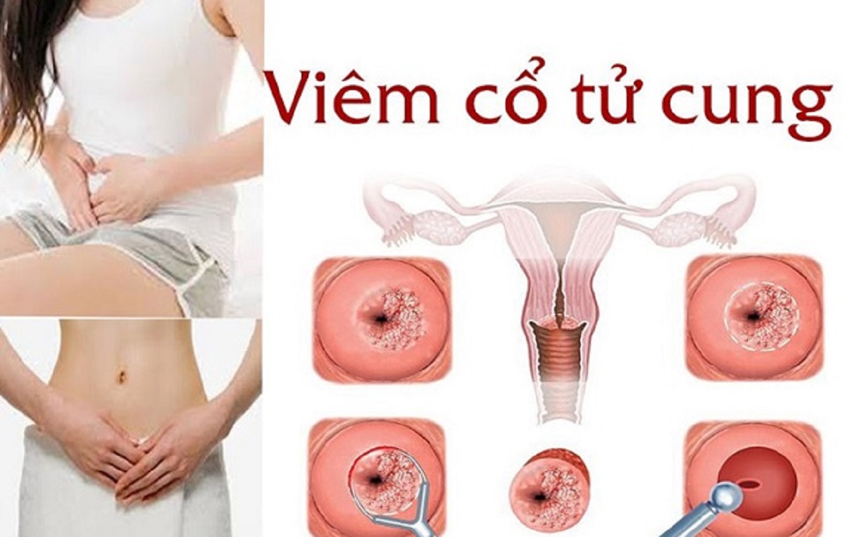 Viêm cổ tử cung là gì? Dấu hiệu nhận biết sớm 5 Viêm cổ tử cung là gì
